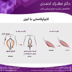 لابیاپلاستی با لیزر