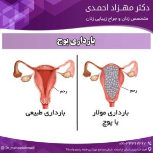 بارداری پوچ دکتر مهزاد احمدی