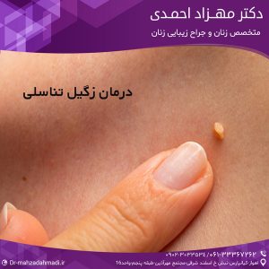 درمان زگیل تناسلی