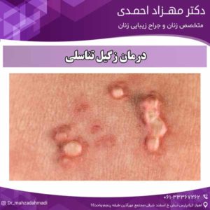 درمان زگیل تناسلی دکتر مهزاد احمدی 