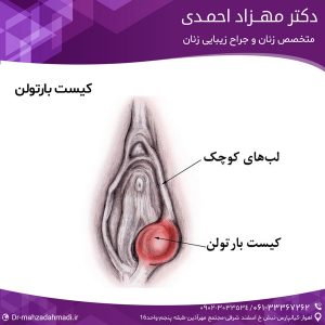 کیست بارتولن