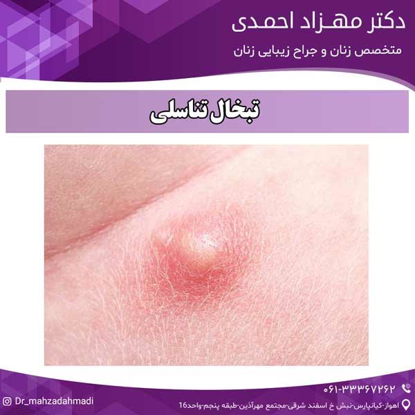تبخال تناسلی دکتر مهزاد احمدی