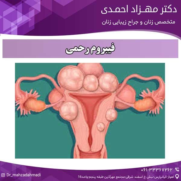 فیبروم رحمی دکتر مهزاد احمدی