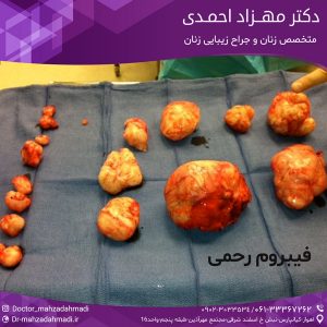 فیبروم رحمی