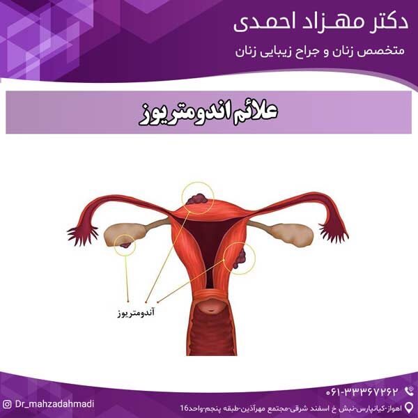 علائم اندومتریوز دکتر مهزاد احمدی