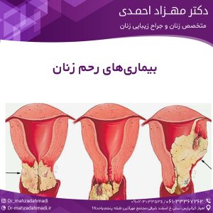 بیماری‌های رحم زنان
