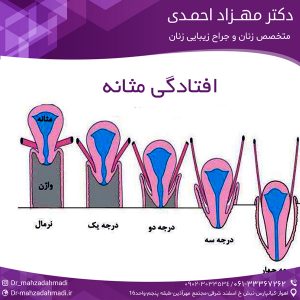 افتادگی مثانه