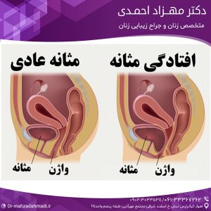 علائم افتادگی رحم ومثانه