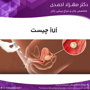 iui چیست ؟