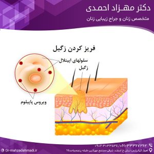 فریز کردن زگیل تناسلی یا کرایو چیست؟