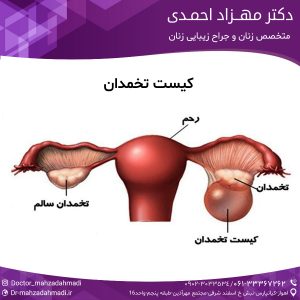 کیست تخمدان