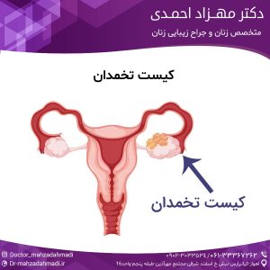 کیست تخمدان