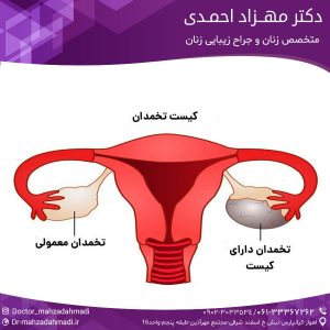 کیست تخمدان